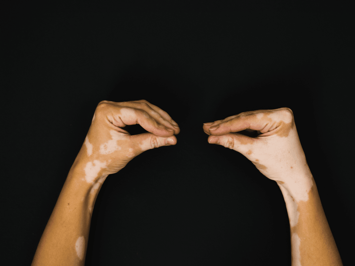 how to prevent vitiligo from spreading