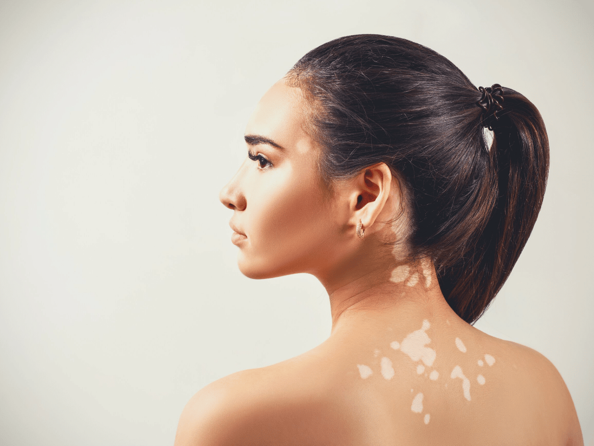 How Does Vitiligo Start and What Are the Symptoms