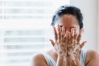 How Common is Vitiligo and Who Might Gets It?
