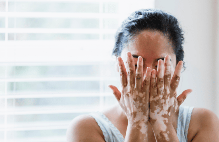 How Common is Vitiligo and Who Might Gets It?