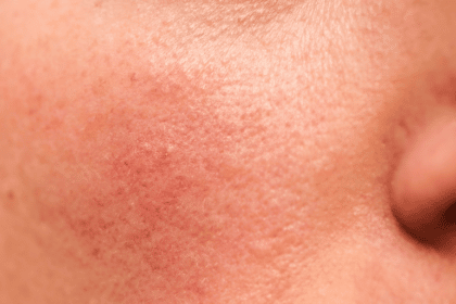 How to Know If You Have Rosacea - Signs and Symptoms