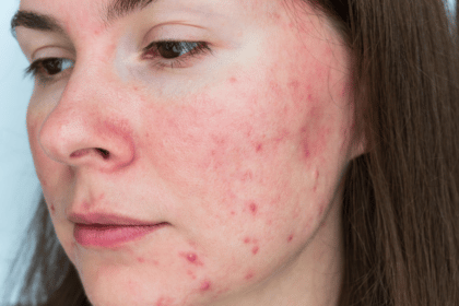 What Causes Rosacea on Face