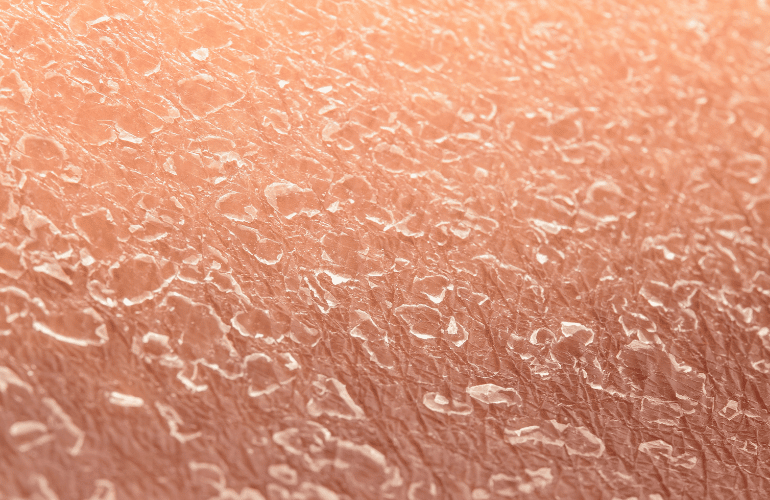 what causes dehydrated skin