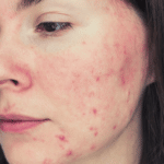 How to Calm Rosacea Flare-Up Fast