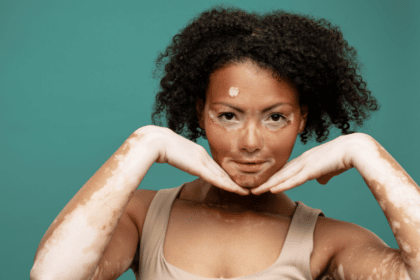 vitiligo question do and don't