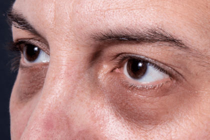 Causes Dark Circles Under Eyes
