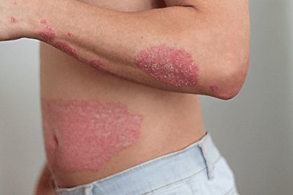 How to Cure Psoriasis Permanently