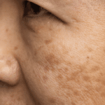 How to Remove Melasma From Your Face Naturally
