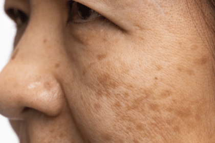 How to Remove Melasma From Your Face Naturally