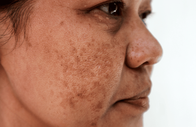 What Causes Melasma on Face