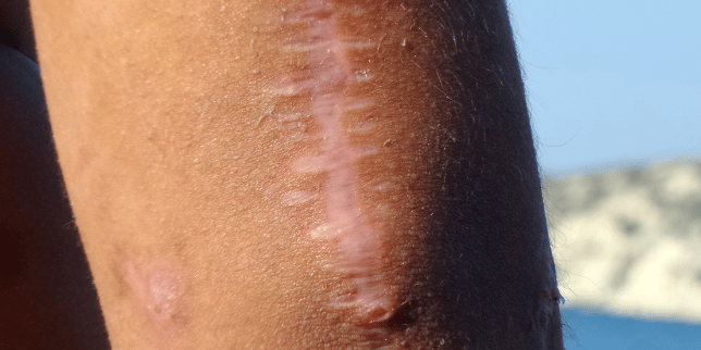licorice root heals scars
