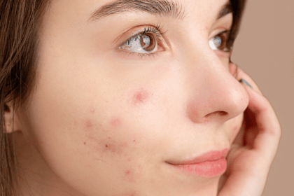 8 Step Skin Care Routine for Acne
