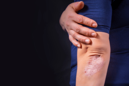 How to Stop Psoriasis from Spreading