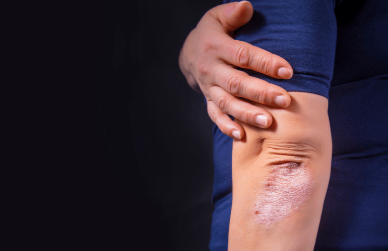 How to Stop Psoriasis from Spreading