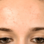 Causes of Shiny and Oily Forehead