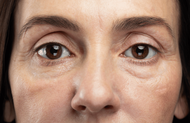 How to Get Rid of Dark Circles Under Eyes Overnight