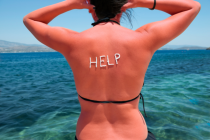 How to Cure Sunburn with Home Remedies