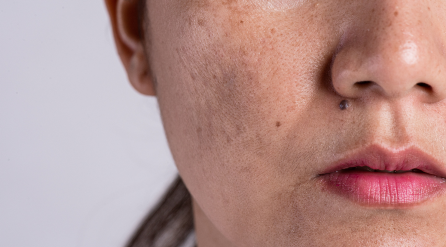 How to Get Rid of Dark Spots on Your Skin